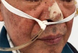 鼻试管操作视频,轻松掌握鼻腔护理技巧