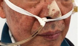 鼻试管操作视频,轻松掌握鼻腔护理技巧